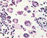 Acute Megakaryoblastic Leukemia Cells (AMKLC)