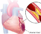 Cardiogenic Shock (CS)