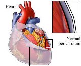 Cardiopericarditis (CP)