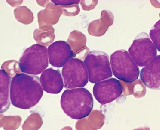 B Lymphoblasts (BL)