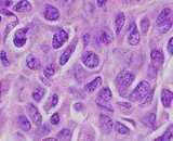 Chondrosarcoma Cells (CC)