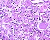 Dermal Mast Cells (DMC)