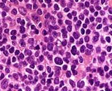 Mantle Cell Lymphoma Cells (MCLC)