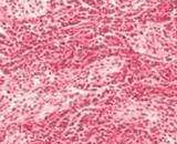 Medulloblastoma Cells (MBC)