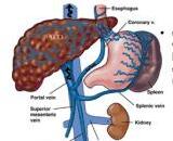 Portal Hypertension (PH)