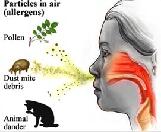 Allergic Rhinitis (AR)