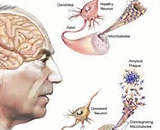 Alzheimer Disease (AD)