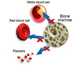 Aplastic Anemia (AA)