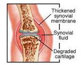 Rheumatoid Arthritis (RA)