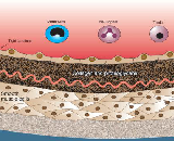 Atherosclerosis (ASVD)