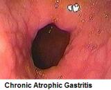 Chronic Atrophic Gastritis (CAG)