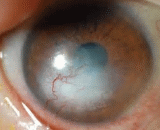 Corneal Scar (CS)