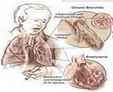 Emphysema