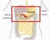 Functional Dyspepsia (FD)