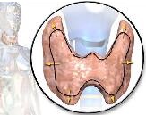 Hyperthyroidism (HT)