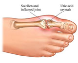 Hyperuricemia (HU)