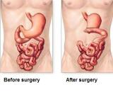 Intestinal Adhesion (IA)