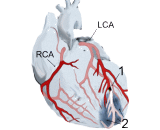 Myocardial Infarction (MI)