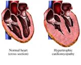 Myocardiosis