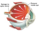 Optic Neuropathy (ON)