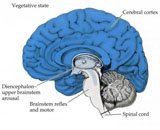 Persistent Vegetative State (PVS)