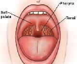 Acute Pharyngitis (AP)