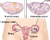 Polycystic Ovarian Syndrome (PCOS)