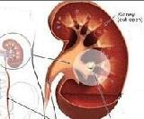 Renal Urolithiasis (RU)