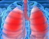 Acute Respiratory Distress Syndrome (ARDS)