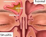 Sinusitis