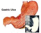 Stress Gastric Ulcer (SGU)