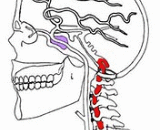 Vertebrobasilar Insufficiency (VBI)