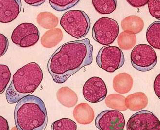 T-lymphoblastic Leukemia (TLL)